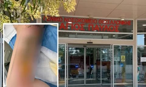 Θεσσαλονίκη: Έγκαυμα 3ου βαθμού σε 20χρονη σε νοσοκομείο