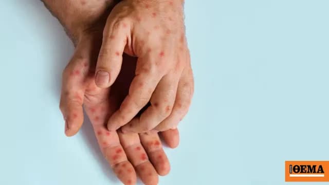 Οι πρώτοι θάνατοι από ιλαρά στην Πενσιλβάνια εδώ και 35 χρόνια