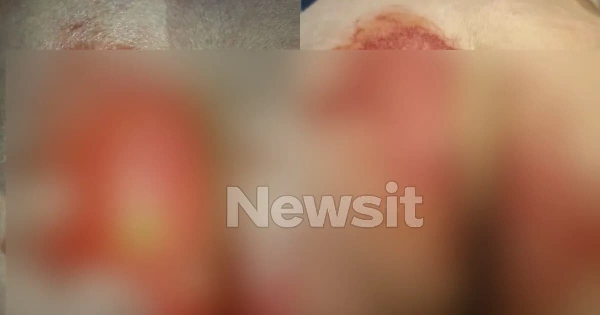 Θεσσαλονίκη: 52χρονη καταγγέλλει εγκαύματα από οξύ σε νοσοκομείο