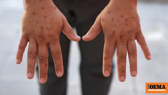 Το πρώτο κρούσμα mpox για το 2026 εντοπίστηκε στα Ιωάννινα