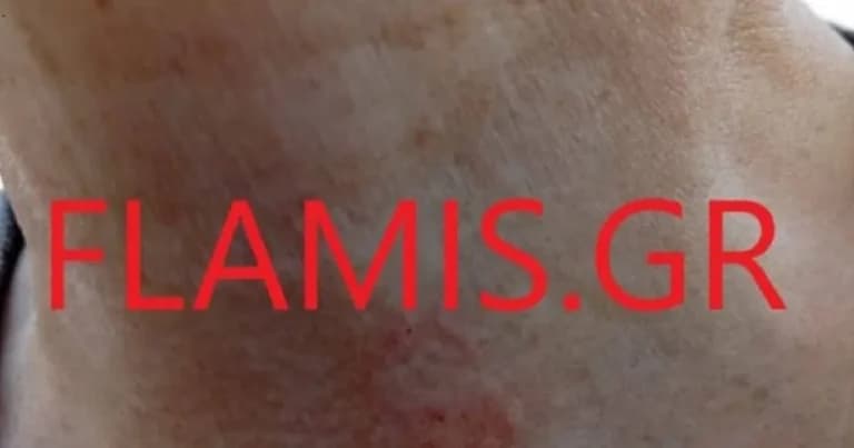 Δάγκωμα λαγοκέφαλου σε λουόμενη στην Πλαζ της Πάτρας