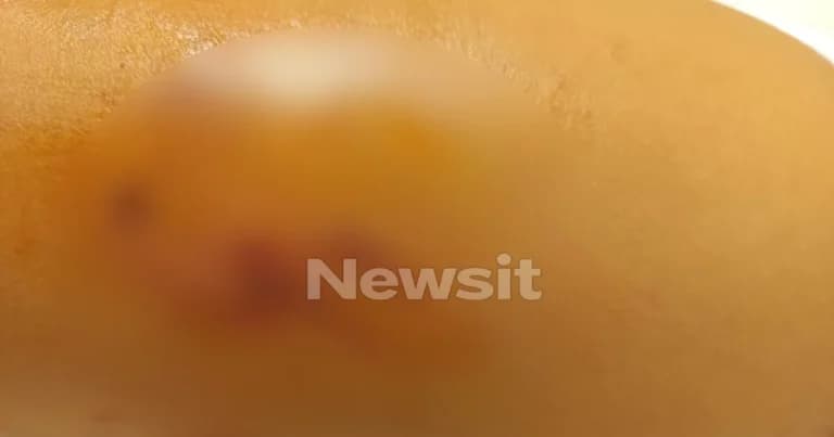 Θεσσαλονίκη: Αγέλη σκύλων επιτέθηκε σε 12χρονη