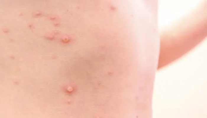 ασθενής mpox νοσοκομείο Ιωαννίνων απομόνωση 2026